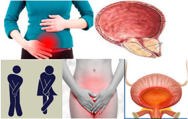 Sinais de cistite em mulheres - ardor e dor ao urinar